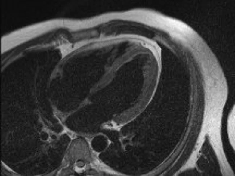 MRT des Herzens - Radiologie | Uniklinikum Erlangen