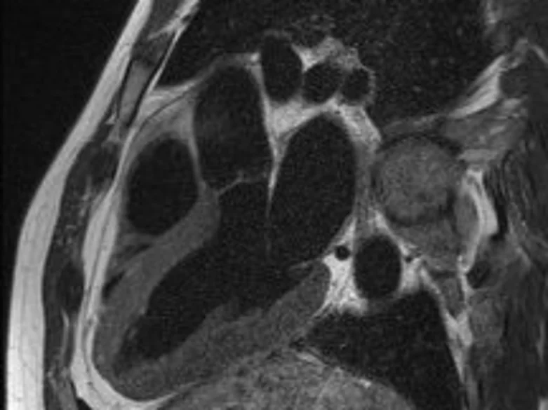 MRT des Herzens - Radiologie | Uniklinikum Erlangen