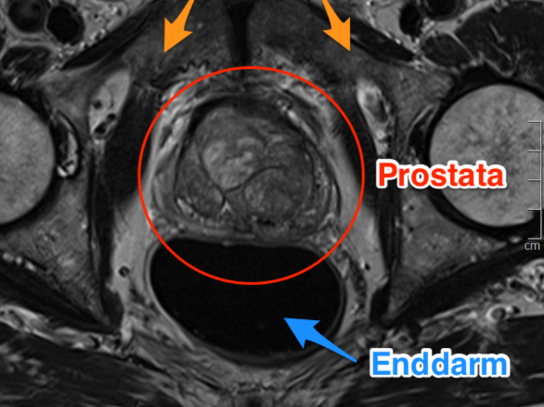 Prostata MRT